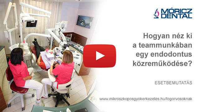 Mikroszkóppal végzett gyökérkezelés 1