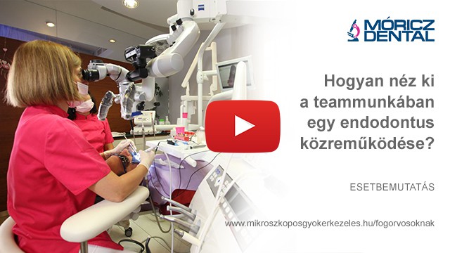 Mikroszkóppal végzett gyökérkezelés 2
