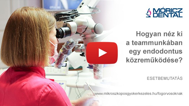 Mikroszkóppal végzett gyökérkezelés 3