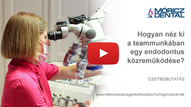 Mikroszkóppal végzett gyökérkezelés 4