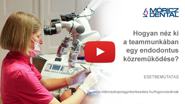 Mikroszkóppal végzett gyökérkezelés 5