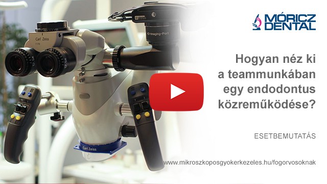 Mikroszkóppal végzett gyökérkezelés 6