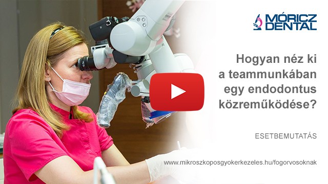 Mikroszkóppal végzett gyökérkezelés 10