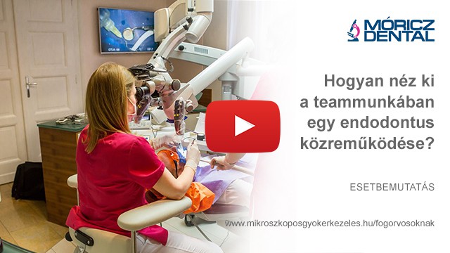 Mikroszkóppal végzett gyökérkezelés 11