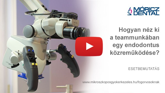 Mikroszkóppal végzett gyökérkezelés 7