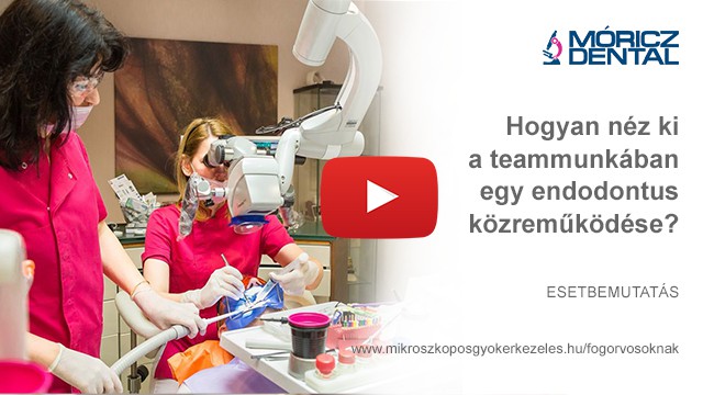 Mikroszkóppal végzett gyökérkezelés 8