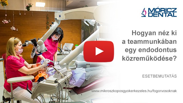 Mikroszkóppal végzett gyökérkezelés 9